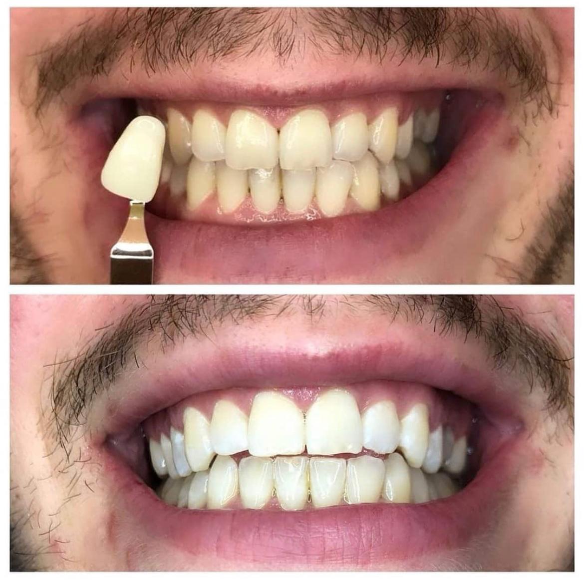 Zahnaufhellung in Möglingen by beautysecret